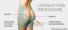 How Can Resolve my Liposuction Problems | Dehli, India