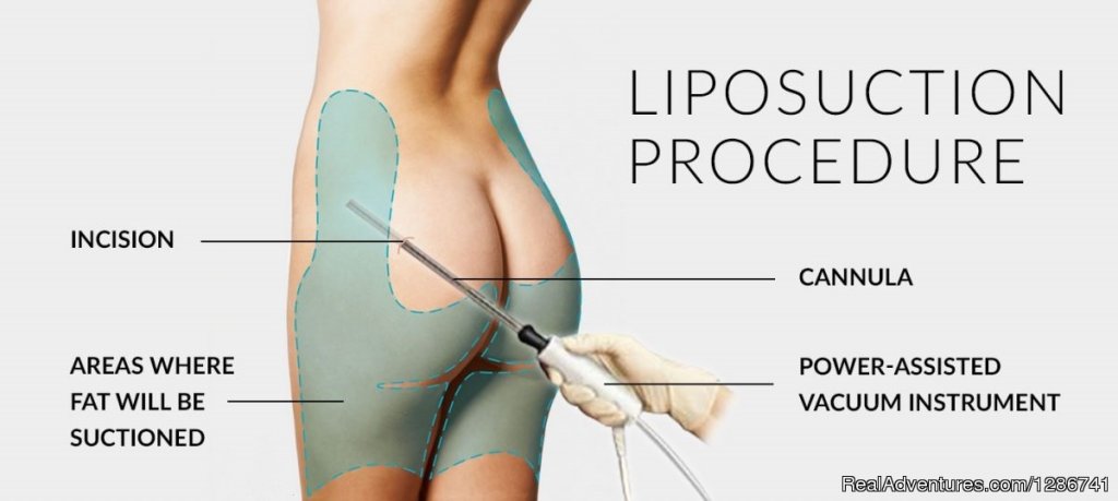 How Can Resolve my Liposuction Problems | Dehli, India | Health Spas & Retreats | Image #1/1 | 